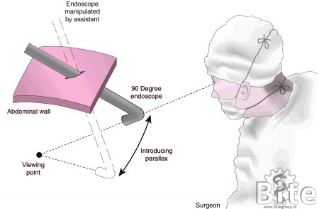 Figuur 4: Verbeterde ruimtelijke perceptie bij minimaal-invasieve chirurgie