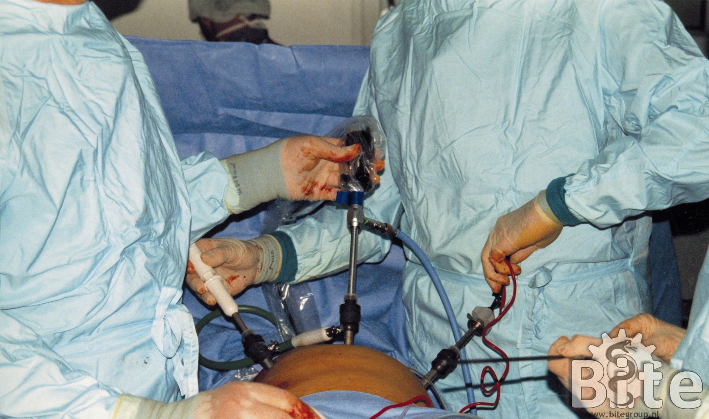 Figuur 3: Laparoscopische operatie in de buikholte